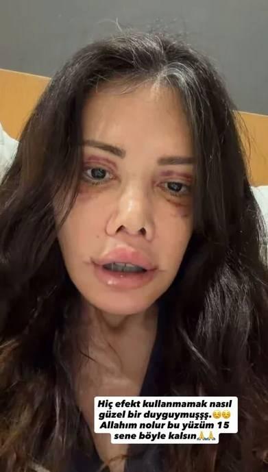 <p><strong>"Y&Uuml;Z&Uuml;M 15 SENE B&Ouml;YLE KALSIN"</strong></p>

<p>Bug&uuml;n bir paylaşım daha yaparak iyileşme s&uuml;recini anlatan Ceran, <strong>"Bug&uuml;n ila&ccedil; i&ccedil;mek i&ccedil;in uyandım. Ben hi&ccedil;bir branştaki doktorlarımızı eleştirmedim. İnşallah hanım kardeşlerim benim gibi kasap doktorlara denk gelip 'ah ah! Didem haklıymış!' demezler. Bir şey demiyorum." ifadelerini kullanırken paylaşımının altına ise, "Hi&ccedil; efekt kullanmamak nasıl g&uuml;zel bir duyguymuş. Allah'ım ne olur bu y&uuml;z&uuml;m 15 sene b&ouml;yle kalsın"</strong> notunu ekledi.</p>
