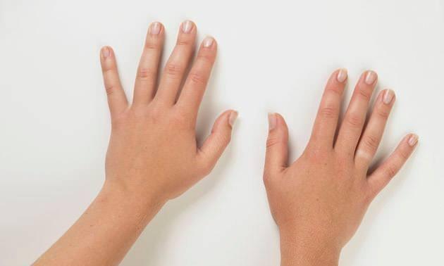 <p><span style="color:#B22222"><strong>PARMAK KESMEK&nbsp;</strong></span></p>

<p>&Ccedil;oğu insan yas tutarken ağlar, dondurma yer, hatta belki gidip bir danışmanla g&ouml;r&uuml;ş&uuml;r. Fakat Papua Yeni Gine'deki Dani Kabilesi yas tutunca u&ccedil; noktalarda bir şey yapıyor: Kendi parmaklarını kesiyorlar. Bu durum genellikle sevdikleri birinin &ouml;lmesi &uuml;zerine kabile &uuml;yelerinin kendi parmaklarını yas g&ouml;stergesi olarak kesmesi şeklinde ger&ccedil;ekleşiyor. Bu uygulama ge&ccedil;en yıllarda yasaklanmış olsa da, bazı &uuml;yeler devam ettiriyor.</p>

<p>&nbsp;</p>
