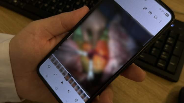 <p>Karın i&ccedil;erisini temizledikten sonra bağırsaktaki yapışıklıkları a&ccedil;tıklarını kaydeden Kamacı, konuşmasına ş&ouml;yle devam etti:</p>

<p>"Kapalı olan bağırsak kısmını &ccedil;ıkardık. Karın i&ccedil;inde enfeksiyon olduğu i&ccedil;in bağırsağını a&ccedil;tıktan sonra iki ucu birbirine dikemedik ve bağırsağını, ileostomi dediğimiz bir ameliyat ile karın duvarına a&ccedil;tık. Ameliyattan sonra yoğun bakımda enfeksiyon tedavisi s&uuml;reci başladı. Enfeksiyon değerleri &ccedil;ok y&uuml;ksekti, yoğun bakım tedavileriyle d&uuml;şt&uuml;. Beslenmesine kadar takip ettik. Ameliyattın &uuml;zerinden 12 g&uuml;n ge&ccedil;ti. Bebeğimiz gayet sağlıklı. Tamamen ağızdan beslenebiliyor."</p>
