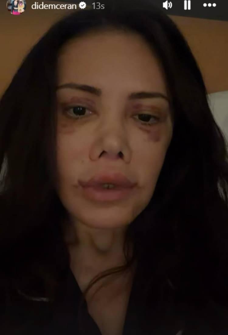 <p>Konuşmakta zorlanan Ceran "Y&uuml;z&uuml;mdeki b&uuml;t&uuml;n kemiklere ağzımın i&ccedil;i kesilerek ulaşıldı. Ağzımın i&ccedil;i dikiş dolu" dedi.</p>

<p>&nbsp;</p>
