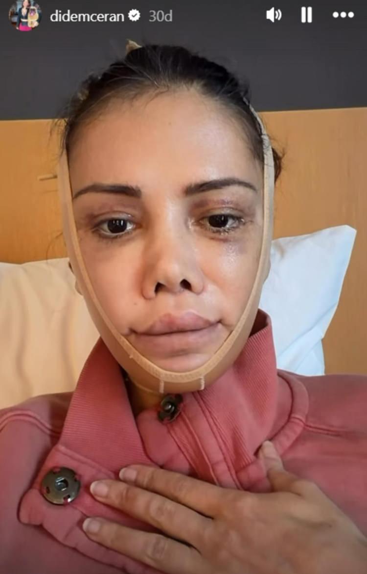 <p><strong>Y&Uuml;Z NAKLİNİN 16.G&Uuml;N&Uuml; DİYEREK PAYLAŞTI</strong></p>

<p><strong>"Y&uuml;z naklimin 16. g&uuml;n&uuml;"</strong> diyerek son halini paylaşan Didem Ceran konuşmasında <strong>"Harika g&ouml;r&uuml;n&uuml;yorum bebek gibi"</strong> dedi.</p>

<p>&nbsp;</p>
