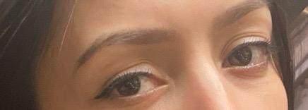 <p>Raporda, Elif T.'nin ifadesinde işlem sonrası g&ouml;z kapaklarında kızarıklık, kabuklanma ve kanama geliştiğini beyan ettiği ancak olay tarihinde bu şikayetlerle bir sağlık kuruluşuna başvurduğuna dair tıbbi kaydın bulunmadığı vurgulandı.</p>
