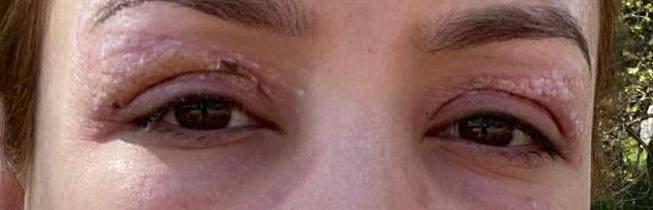 <p><span style="color:#A52A2A"><strong>"&Ccedil;EVREMDEKİLER FARK ETTİ"</strong></span></p>

<p>&nbsp;</p>

<p>Yaşadığı s&uuml;rece ilişkin konuşan Elif T., <em>"İşlemden sonra g&ouml;z&uuml;m&uuml;n 15 g&uuml;n arayla yıkanması gerektiği s&ouml;ylendi. Ben de verilen talimatlara uydum ve salonla iletişimi kesmedim. Bir s&uuml;re sonra g&ouml;z kapağımda kabuklanma oluştu. Bunun 15 g&uuml;n i&ccedil;inde ge&ccedil;eceği s&ouml;ylendi. Ancak 15 g&uuml;n ge&ccedil;mesine rağmen kabuklanma devam etti. Daha sonra o b&ouml;lgede kanama meydana geldi. G&uuml;zellik salonu ile tekrar iletişime ge&ccedil;tiğimde enfeksiyon kaptığım s&ouml;ylendi ve bunun benden kaynaklandığı belirtildi. Bu s&uuml;re&ccedil;te hastaneye gittim ve doktorun verdiği kremleri kullanarak tedavi olmaya &ccedil;alıştım. Aradan birka&ccedil; ay ge&ccedil;tikten sonra ise &ccedil;evremdekilerin fark etmesi ile g&ouml;z kapağımda asimetrik bir bozukluk olduğunu &ouml;ğrendim. Bu benim kendi başıma fark edebileceğim bir durum değildi, birilerinin s&ouml;ylemesi ile anladım. Bunu birka&ccedil; ay sonra fark etmemin sebebi ise g&ouml;z kapağının fazla yakılması nedeniyle g&ouml;z&uuml;n kendini &ccedil;ekmiş olmasıdır." </em>dedi.</p>
