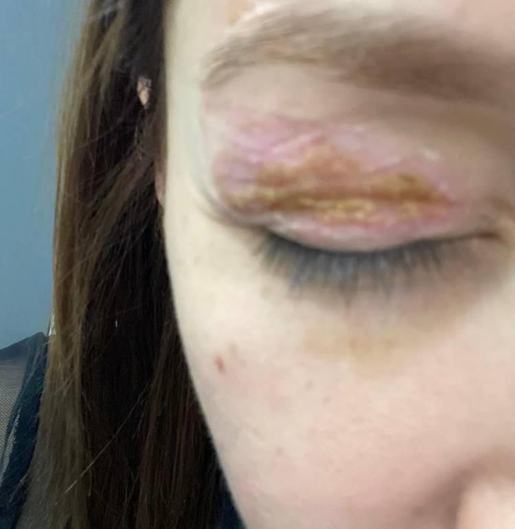 <p><span style="color:#A52A2A"><strong>"RAPORA RAĞMEN TALEBİM REDDEDİLDİ"</strong></span></p>

<p>&nbsp;</p>

<p>Mahkemeye başvurduğunu ve kendisine bir a&ccedil;ıklama yapılmadığını &ouml;ne s&uuml;ren Elif T., <em>"Ben kendilerine bu durumdan rahatsız olduğumu ve mahkemeye başvuracağımı s&ouml;yledim. Onlar da bana 'Mahkemeye başvurabilirsiniz' diye d&ouml;n&uuml;ş yaptılar. Mahkemeye başvurduktan sonra Adli Tıp Kurumu'na gittim. Orada g&ouml;z kapağındaki kaymanın ka&ccedil; milimetre olduğuna kadar detaylı sonu&ccedil;lar &ccedil;ıktı. Ancak savcılık, bu rapora rağmen talebimi reddetti. Dosya mahkemeye bile taşınmadı ve savcılık 'kovuşturmaya yer yoktur' kararı verdi. Bu karara itiraz ettim ama itirazım da reddedildi. Gerek&ccedil;e olarak ise asimetrik bozukluğu fark ettiğim anda hastaneye başvurmamış olmam g&ouml;sterildi."</em><strong><em> </em></strong>diye konuştu.</p>
