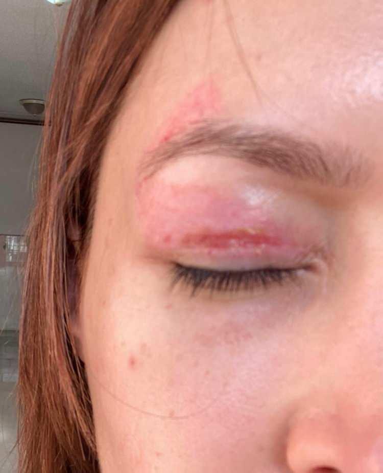 <p>Elif T.'nin hazırlanan Adli Tıp Kurumu raporunda;&nbsp;<strong><em>plazma pen işleminin kişinin isteğine bağlı olarak uygulanabildiği,&nbsp;</em></strong>işlem sonrası yara kabuklanması, kızarıklık, nedbe ve hiperpigmentasyon gibi durumların her t&uuml;rl&uuml; dikkat ve &ouml;zene rağmen komplikasyon olarak ortaya &ccedil;ıkabileceği belirtildi.</p>
