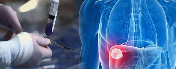 <p><strong><em>&Ccedil;alışmada t&uuml;t&uuml;n, alkol, y&uuml;ksek v&uuml;cut kitle indeksi, fiziksel hareketsizlik, hava kirliliği, ultraviyole radyasyon ve enfeksiyonlar dahil 30 &ouml;nlenebilir risk fakt&ouml;r&uuml; değerlendirildi. T&uuml;t&uuml;n kullanımı tek başına t&uuml;m yeni kanser vakalarının y&uuml;zde 15&rsquo;inden sorumlu. Enfeksiyonlar y&uuml;zde 10, alkol ise y&uuml;zde 3 oranında etkili. Yani sigara h&acirc;l&acirc; a&ccedil;ık ara birinci sırada."</em></strong> şeklinde konuştu.</p>
