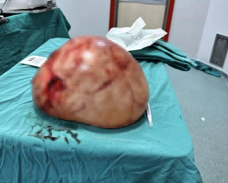 <p>Van Y&uuml;z&uuml;nc&uuml; Yıl &Uuml;niversitesi (Van YY&Uuml;) Dursun Odabaşı Tıp Merkezine&nbsp;karın ağrısı ve kansızlık şikayetleriyle başvuran 35 yaşındaki kadın hastada, yapılan tetkikler sonucunda karın i&ccedil;inde dev kistik kitle tespit edildi. Genel Cerrahi Uzmanı Do&ccedil;. Dr. &Uuml;mit Haluk İliklerden tarafından acil ameliyata alınan hastanın karnından 35x25 santimetre boyutlarında kitle &ccedil;ıkarıldı.</p>

<p>&nbsp;</p>
