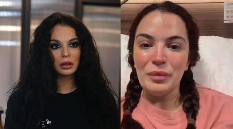 Doktor hatası y&uuml;z&uuml;nden 6 kez ameliyat oldu! Aslı Bekiroğlu son durumunu paylaştı