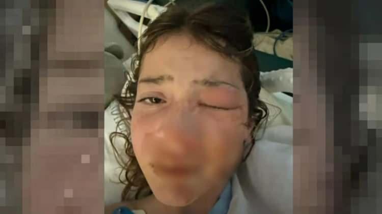 <p><strong>10 yaşıdaki Avustralyalı Violet, sertleşen oyuncağını ısıtıp yumuşatmak isterken oyuncağın y&uuml;z&uuml;nde patlamasıyla birlikte facia yaşadı.&nbsp;</strong></p>
