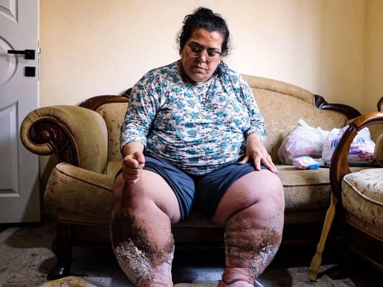 <p>Adana'da oturan, 1'i y&uuml;zde 40 zihinsel engelli 3 &ccedil;ocuk annesi Fatma Dinsever, ge&ccedil;en yıl İzmir'de yaşadığı sırada halk arasında 'fil hastalığı' olarak bilinen lenf&ouml;deme yakalandı.&nbsp;</p>
