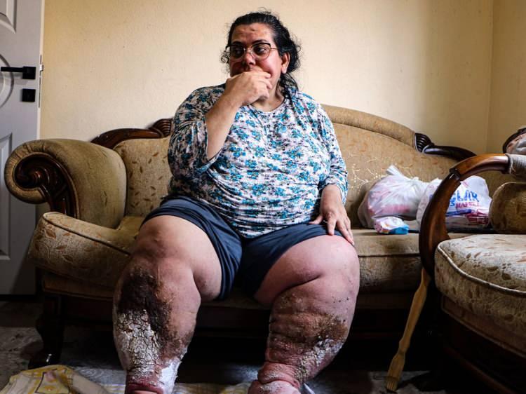 <p>Dinsever, maddi imkansızlıklar nedeniyle tedavisini yarıda bırakmak zorunda kaldı.&nbsp;</p>
