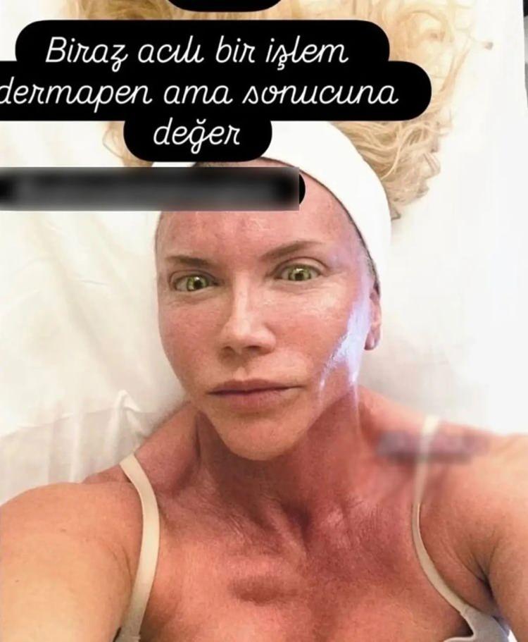 <p>Fiziksel g&ouml;r&uuml;n&uuml;m&uuml;yle sık sık adından s&ouml;z ettiren ağır antrenmanları ile fiziksel değişimi dikkat &ccedil;eken Suden&rsquo;in dermapen işlemi sosyal medyada merak uyandırmıştı.</p>
