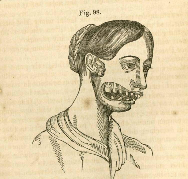<p>Sonu&ccedil;, tıp literat&uuml;r&uuml;nde fosfor nekrozu olarak bilinen ve halk arasında "phossy jaw" adı verilen son derece ağır bir hastalık olabiliyordu.</p>
