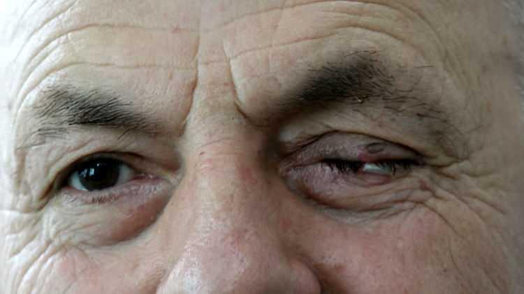<p>A&ccedil;ıklamada, tedavi s&uuml;recinde hasta ile s&uuml;rekli iletişimde olunduğu, hastanın operasyon sonrası dikkat etmesi gereken hijyen kurallarına ilişkin &ouml;nceden bilgilendirildiği belirtildi.&nbsp;</p>

<p>&nbsp;</p>

<p>Hastanın operasyondan bir g&uuml;n sonra kontrol amacıyla geldiği hastanede g&uuml;venlik kamerası g&ouml;r&uuml;nt&uuml;lerinde elindeki mendille y&uuml;z&uuml;n&uuml;, alnını ve ardından da ameliyatlı g&ouml;z&uuml;n&uuml; sildiğinin belirlendiği ifade edildi.&nbsp;</p>

