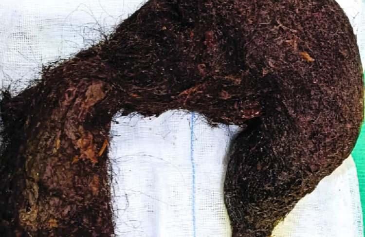 <p>9 YAŞINDAN BERİ GİZLİCE YUTUYORDU</p>
