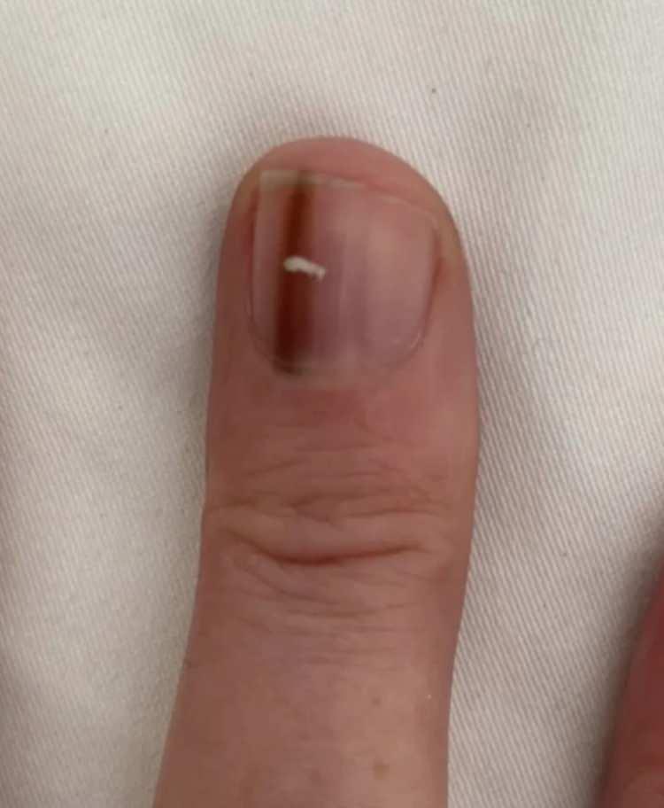 <p>İlk olarak doktora başvuran Misselbrook&rsquo;a bunun basit bir morluk olduğu ve endişe etmesine gerek olmadığı s&ouml;ylendi.&nbsp;</p>
