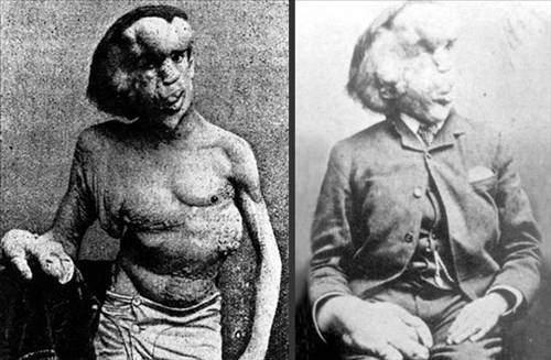 <p>Para kazandığı gösterilerden birinde kendisini gören doktor ona terapi uygulamaya başladı. Joseph Merrick’in Proteus sendromundan muzdarip olduğu ortaya çıktı. David Lynch’in Fil Adam filmine de esin kaynağı olan Merrick 27 yaşınd uykusunda öldü.</p>