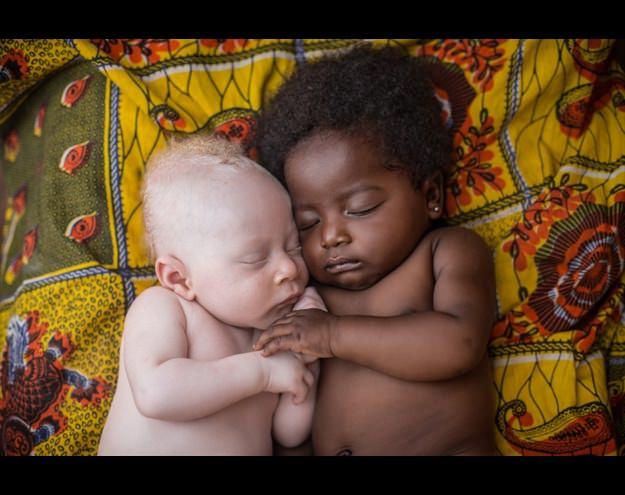 <p>3 haftalık albino hastası bebek, şekerleme yapmak i&ccedil;in kuzenine sokulurken</p>