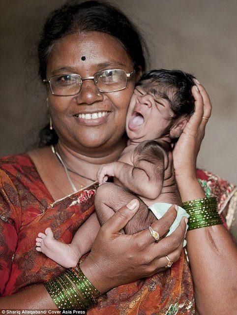 Bahtsız bebek ailenin 2 teyzesi ve annesi gibi Kurt Adam Sendromu ile d&uuml;nyaya geldi. Orta&ccedil;ağ'dan bug&uuml;ne, sadece 50 vakası bulunan bu sendroma rağmen Anne Savita, kızını her ne olursa olsun sevdiğini ve seveceğini ancak yine de kızı i&ccedil;in &uuml;zg&uuml;n olduğunu s&ouml;yledi.