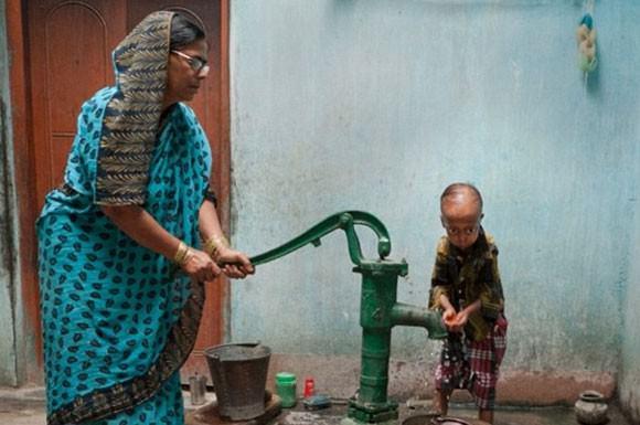 <p>Progeria denilen bu hastalık, v&uuml;cudun normalden 8 kat daha hızlı yaşlanmasına neden oluyor.</p>