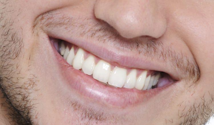 <p>Diş beyazlatma, karbamid peroksit ve türevlerinin kullanılırak yapılan bir işlemdir. Kullanılan maddeler sayesinde oksijen açığa çıkarılarak dişin kendi rengine gelir. Diş beyazlatma işlemleri ofis ve ev tipi olmak üzere ikiye ayrılır.</p>

