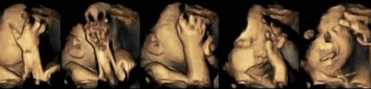 <p>Çıkan sonuç ise hayret ettirdi. Sigara kullanan annelerin <strong>fetüsleri ultrasonda aşırı stresli ve rahatsız gözüktü. Acı çekermiş gibi bir yüz ifadesi olan bu bebeklerin ağız hareketleri de oldukça fazlaydı.</strong></p>
