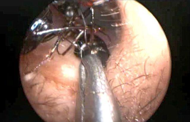 <p>Shreya'nın ebeveynleri, k&uuml;&ccedil;&uuml;k kızlarının kulağından her g&uuml;n ortalama 10-15 kadar karıncanın dışarı &ccedil;ıktığını kaydetti.</p>
