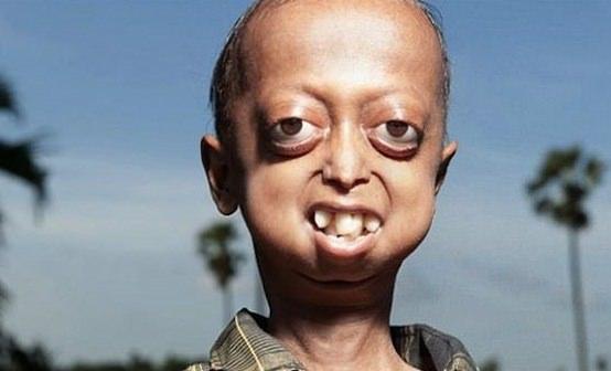 <p>Progeria</p>
