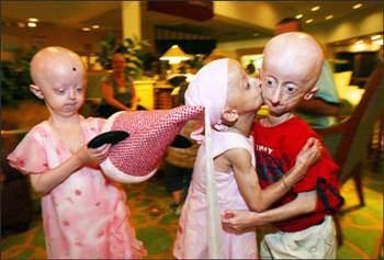 <p>Progeria nadir görülen bir hastalıktır. Dünyada sadece bu hastalığa sahip yaşayan 48 insan bulunmaktadır. Bunun yanında, 5 çocuğu bu hastalığa sahip bir aile vardır.</p>