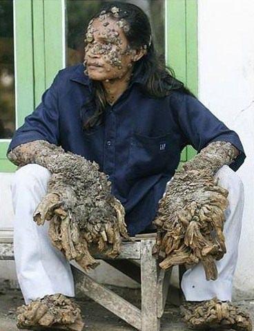 <p>Epidermodysplasia Verruciformis</p>
<p> </p>