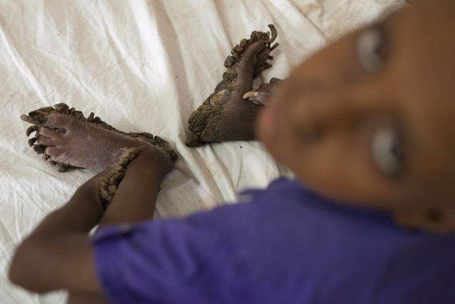 <p>Mirror'un haberine göre; Bangladeş'in Thakurgaon şehrinde yaşayan 7 yaşındaki Ripon Sarker, ne ellerini ne de ayaklarını kullanabiliyor. Yemeğini bir başkasının yardımı olmadan yiyemiyor, yürüyemiyor. 'Epidermodysplasia Verruciformis' hastalığı yüzünden adeta ağaç adama dönüşüyor. </p>
