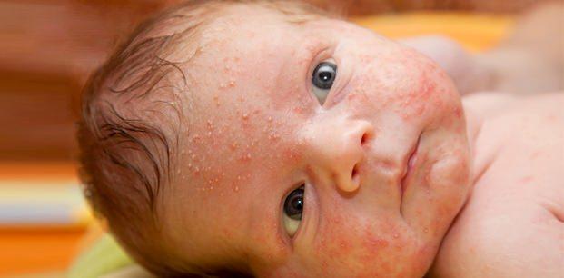 <p><strong>SARIMSI DÖKÜNTÜLER</strong></p>

<p>Pek çok bebeğin gövdesinde ve yüzünde kızaran alanların üzerindeki sivilceye benzeyen sarımsı deri döküntüleridir. Sağlığı yerinde olan bebeklerde görülür ve kendiliğinden geçer.</p>
