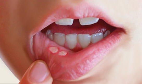 <p><strong>AFT</strong></p>
<p>Ağız içinde pamukçuk benzeri yaralar tıp dilinde lökoplazi olarak tanımlanır.</p>
<p>Bu yaralar, diğer yaralar gibi kolay kolay tedavi edilemez.</p>