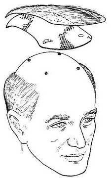 <p><strong>Sabitlenen peruk - 1</strong><br />
<br />
Kellik problemi yaşanlar için 1997'de tasarlanan bu icat, kafatasına vidalar ile sabitlenen peruk ile kellik sorununu kökten çözüyor. Ancak vidaların ilerleyen zamanlarda beyne zarar verebildiği söyleniyor.</p>
