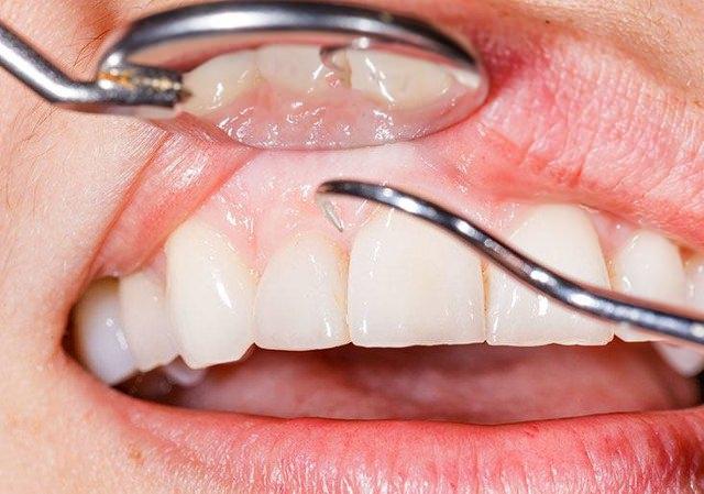 <p>Diş etlerinde oluşan kırmızılık ve kanama sağlıksız diş etlerinin belirtisidir. Diş eti hastalıklarının başında bakteri plağı gelir. Bakteri plakları dişlerin düzgün temizlenmemesinden oluşur.</p>
