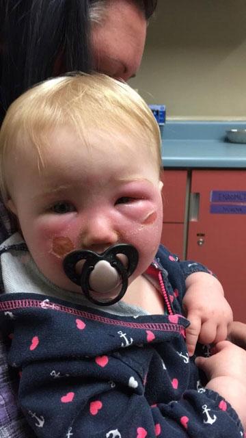 <p>Rebecca Cannon isminde bir anne, henüz 14 aylık olan bebeğinde kullandığı güneş kremini unutunca normal bir güneş kremini bir krem yüzüne sürdü. </p>
