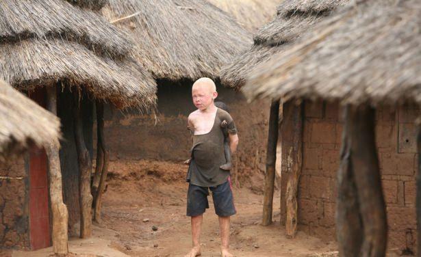 <p>Tanzanya'da albino olmak adeta bir korku filminde başrol oyuncusu olmak gibi.</p>

<p> </p>
