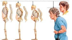 <p>Osteoporoz ne kadar ileri yaş hastalığı olarak bilinse de belli bir dönemden sonra birdenbire ortaya çıkmaz. Yaşanılan hayat tarzı hastalığa zemin oluşturan düşük kemik kalitesi ve yoğunluğunun gelişmesini ciddi şekilde etkiler. </p>
