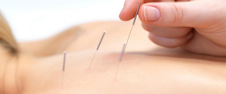 <p>Akupunktur özellikle ağrı tedavisinde kullanıldığında, etkili sonuçlar verir. Akupunktur tek başına elbette etkili değildir. Modern tıp ile birlikte yürütülmeli, tanı tam olarak konulmadan, akupunktur uygulamasından kaçınılmalıdır. </p>
