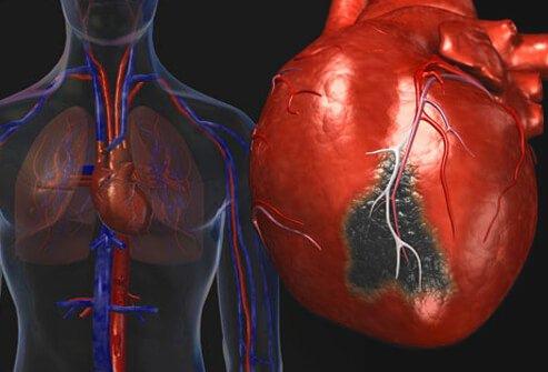 <p>Dünyada ölüm nedenleri arasında ilk sırada yer alan kalp damar hastalıklarından korunmanın yolu düzenli beslenme ve düzenli bir hayattan geçiyor. </p>
