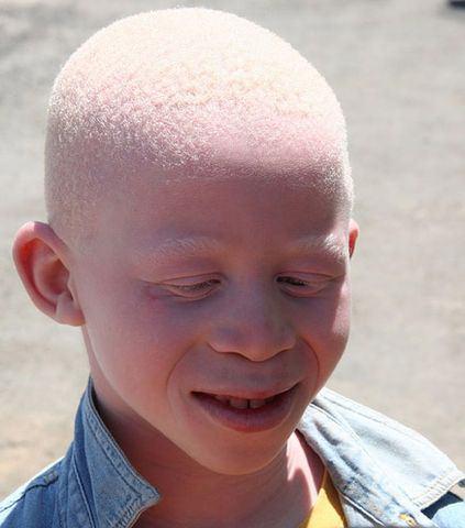 <p><strong>ALBİNİZM:</strong><br />
<br />
Albino olarak adlandırılan albinizm hastalarında, Cilde, saça ve gözlere renk veren melanin pigmenti vücutta ya hiç bulunmuyor ya da çok az bulunuyor. </p>
