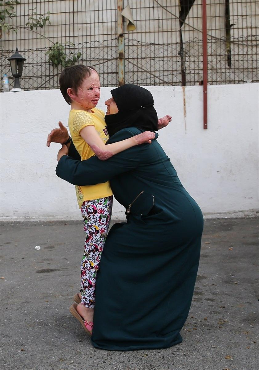<p>Suriye'nin İdlib kentinde evlerine düşen bomba sonucu elleri ile yüzü yanan ve tedavi görmek için geldiği Türkiye'de 8 aydır anne ve kardeş hasreti çeken 8 yaşındaki Hiba Mekzum'un özlemi, Cumhurbaşkanlığı ve hayırseverlerin desteğiyle giderildi.</p>

<p> </p>
