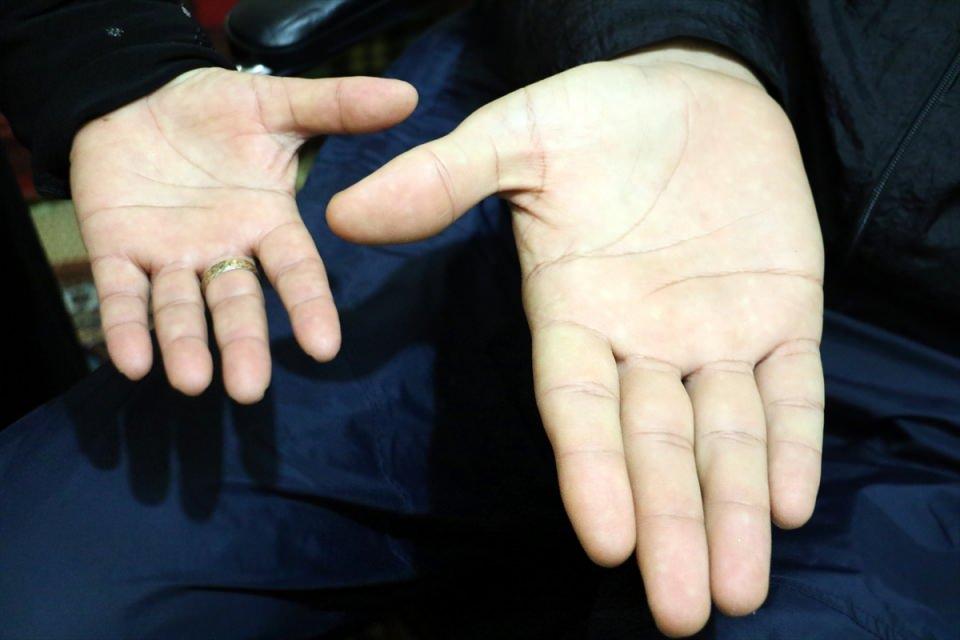<p>Türkmen, AA muhabirine yaptığı açıklamada, bir aydır ailesinin desteği olmadan ayağa kalkamadığını belirterek, boy uzama sorununu kısmen aştıktan sonra bu sefer de yürüyememe sıkıntısıyla karşılaştığını söyledi.</p>