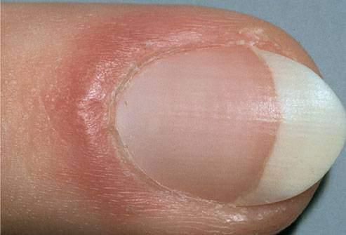 <p><strong>DALGALI TIRNAK</strong></p>
<p>Tırnakların normal hali pürüzsüdür. Eğer dalga dalga bir şekillenme var ise demir eksikliği, arterit veya lupus hastalığının habercisi olabilir.</p>