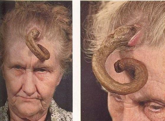 <p>Cutaneous Horns Korn kutaneum (deride boynuzsu çıkıntı), uzunluğu birkaç milimetre ile birkaç santimetre arasında değişen, boynuzumsu görünümde hiperkeratotik lezyonlardır. Korn kutaneum sıklıkla yüz, kulaklar ve güneş gören diğer alanlarda görülür.</p>
<p> </p>
