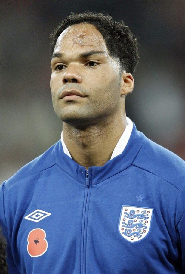 <p>Joleon Lescott'ın yüzündeki yara küçüklüğünden kalma bir trafik kazasından.</p>
