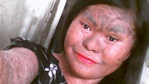 <p>Filipinler'de yaşayan 17 yaşındaki Floraine Nalugon 600.000 kişide bir görülebilecek bir hastalığa sahip. </p>
<p> </p>