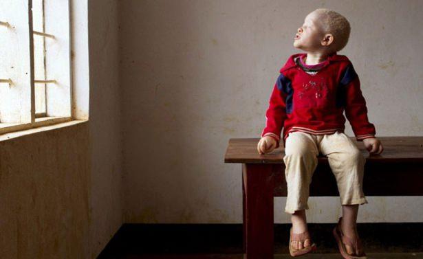 <p>Bir albinonun kafa derisi, elleri ve ayakları 250 bin dolara kadar çıkan paralara satılıyor.</p>

<p> </p>
