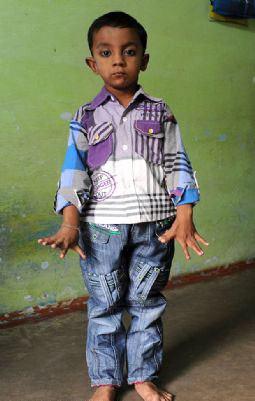 Ama bu farklılık onu olumsuz etkilemişe pek benzemiyor. O, Bhopal'daki tek 25 parmaklı &ccedil;ocuk olmanın gururunu ve keyfini yaşıyor.