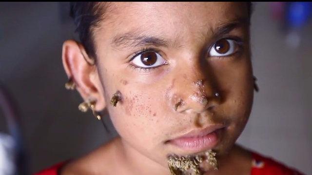 <p>10 yaşındaki Sahana Khatun, dünyada bir ilk oldu. Bangladeş'in Başkenti Dakka'da yaşayan küçük kız ağaç adam sendromuna yakalandı. </p>
